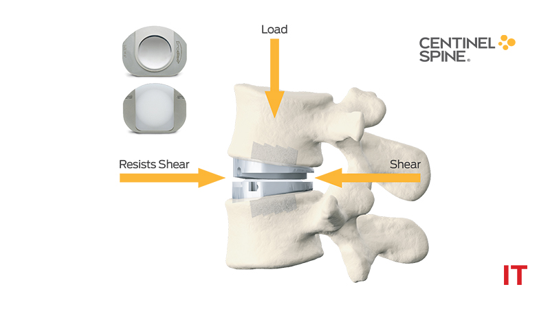 Centinel Spine Continues Drive to Number One Global Market Position in ...